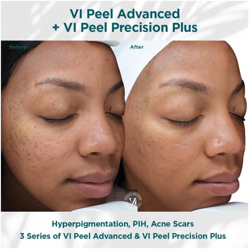 Hyperpigmentation-PIH- -Acne-Scars